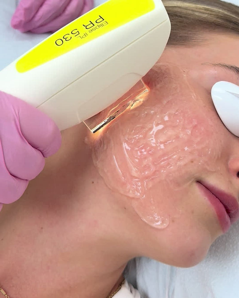 IPL PHOTOFACIAL